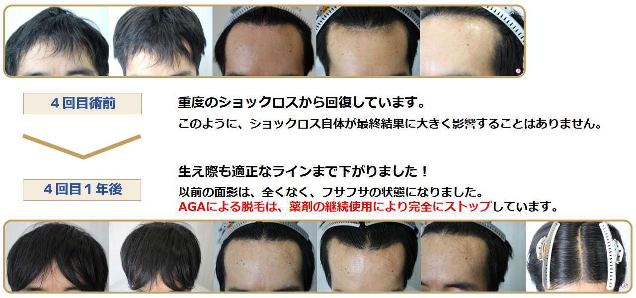 4回目植毛術の術前術後写真