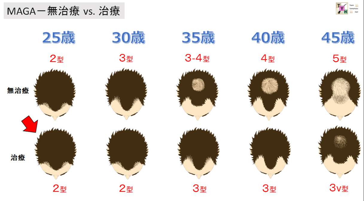 AGA早期治療と放置の比較