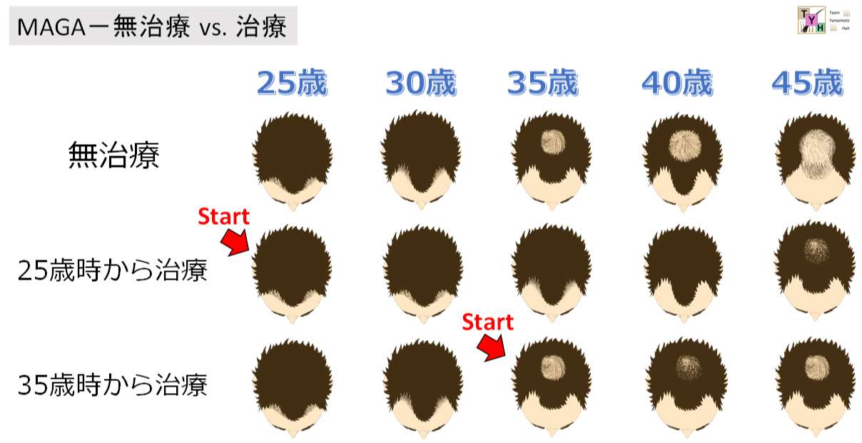 治療開始時期の違いによるAGA進行の差