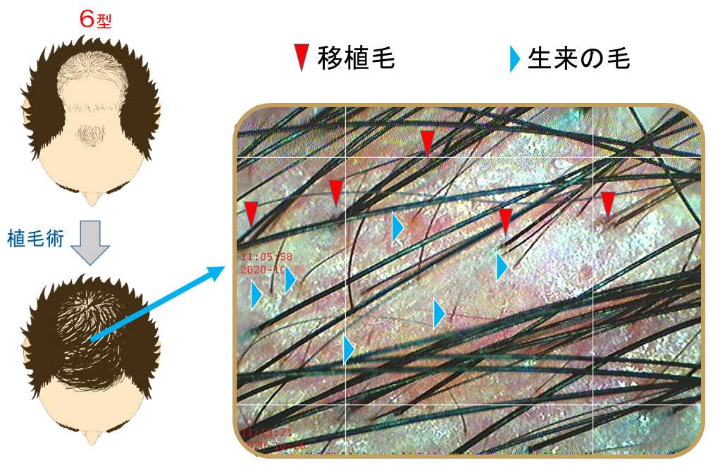 植毛術を行うタイミング