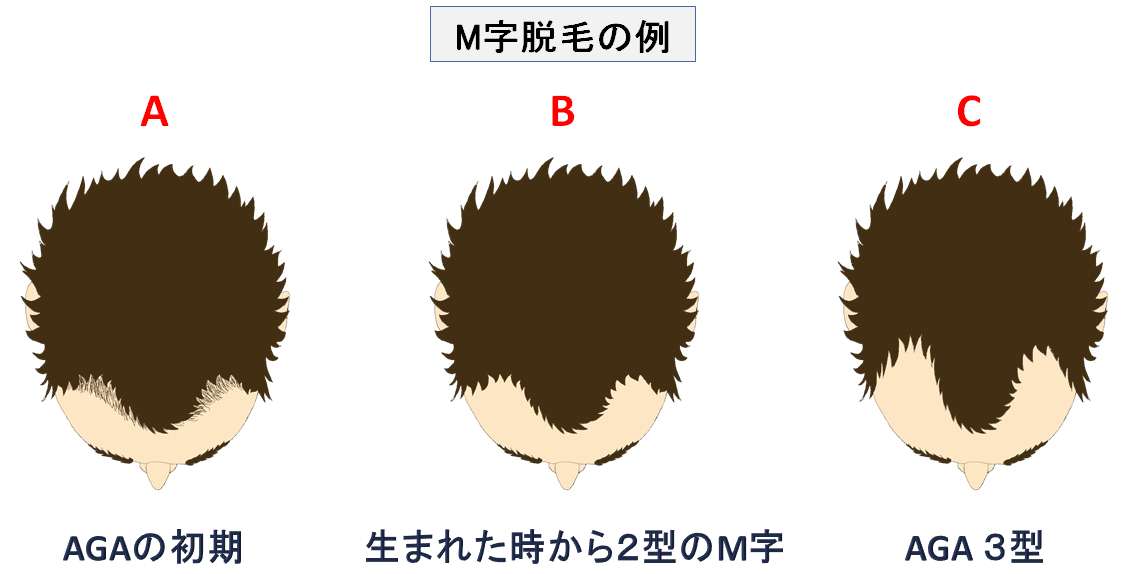 M字脱毛の治療