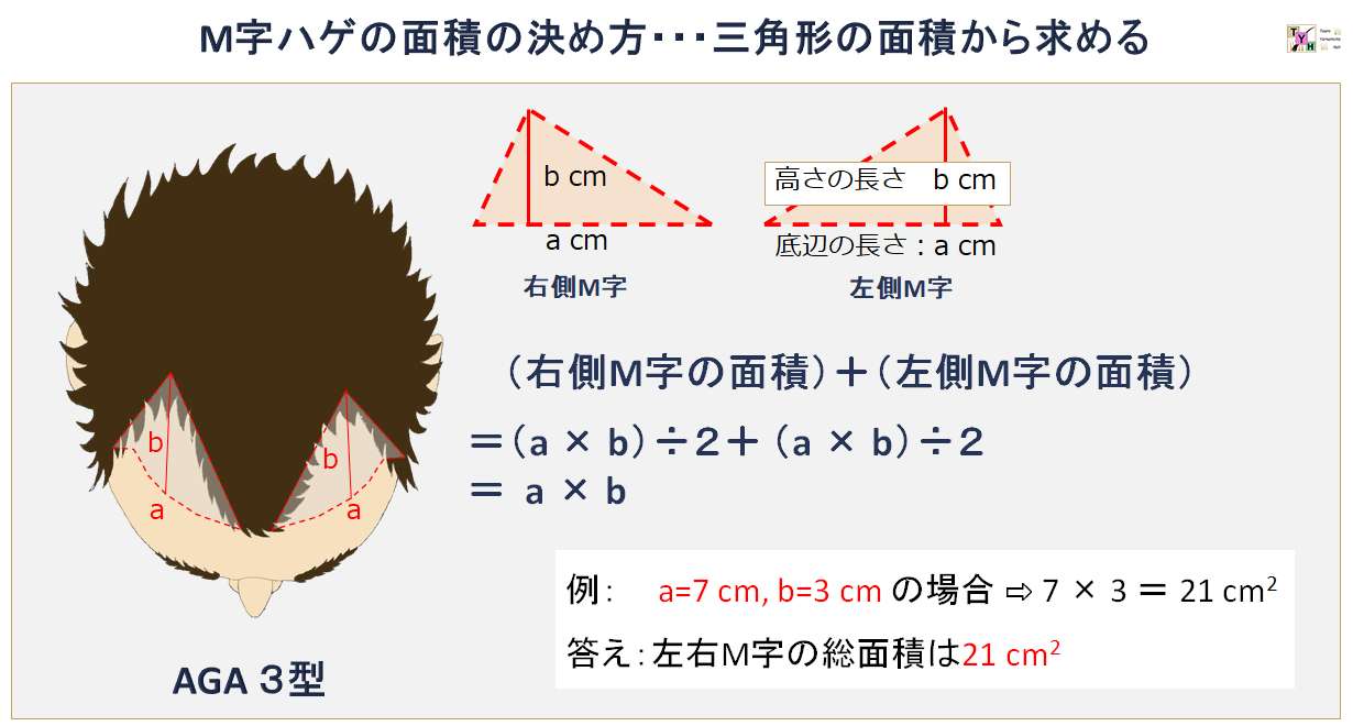 M字脱毛のグラフト数計算