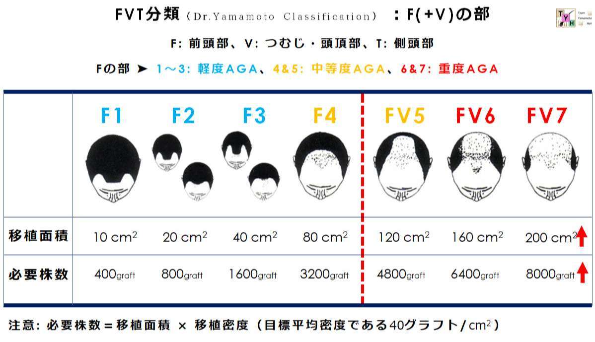 男性AGAの進行型と必要グラフト数