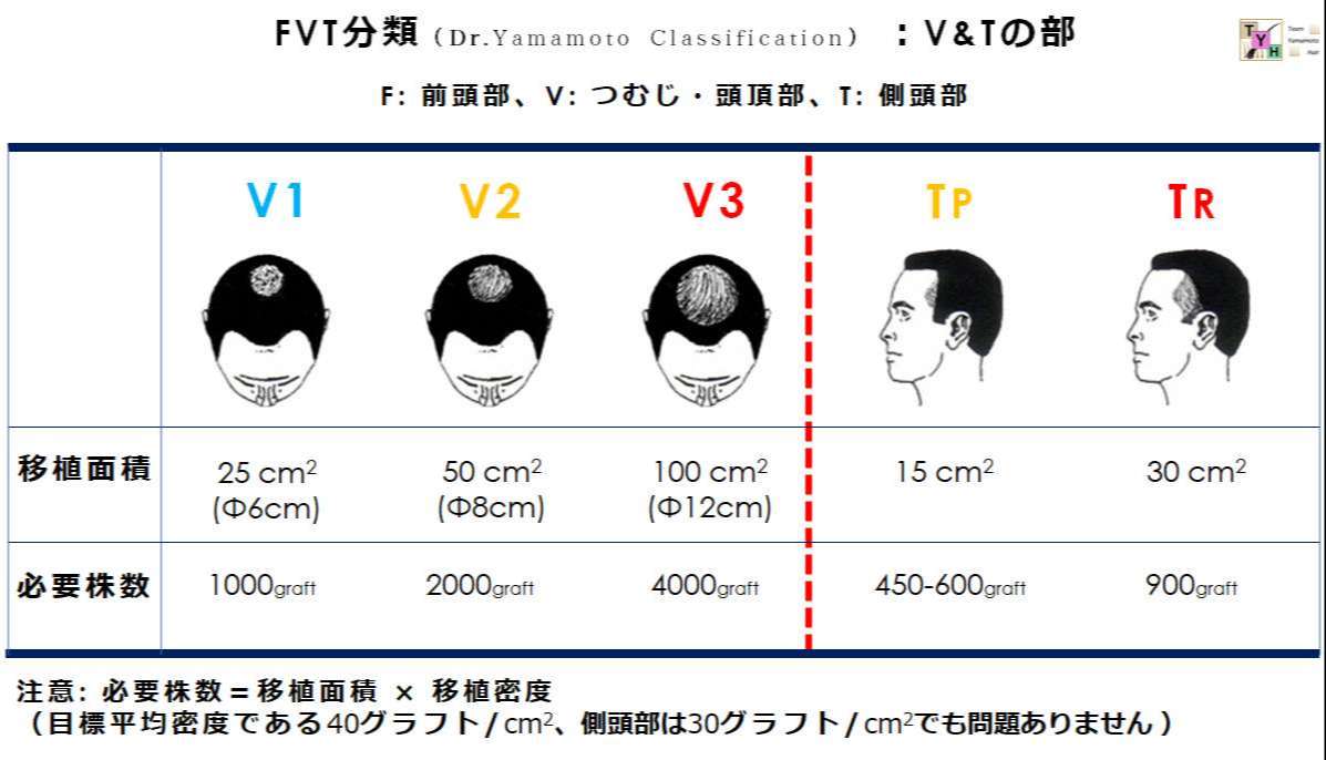 頭頂部・側頭部の脱毛進行と必要グラフト数