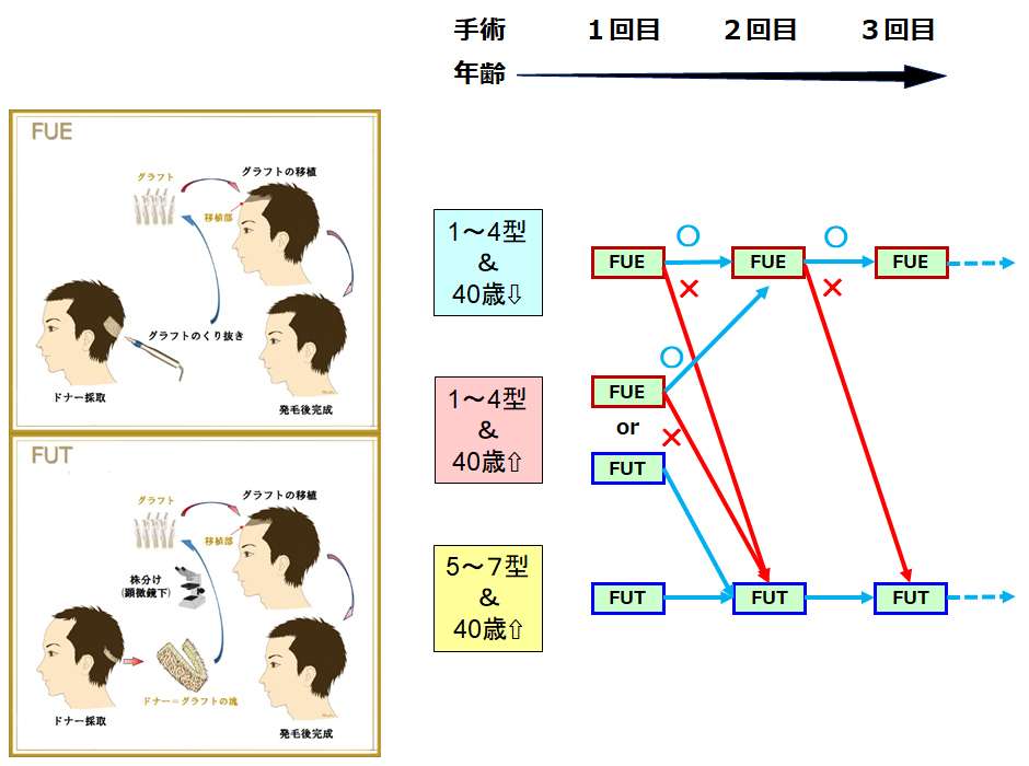 FUEとFUTの年齢による選択