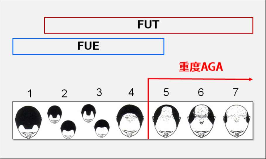 AGAタイプ別の術式選択