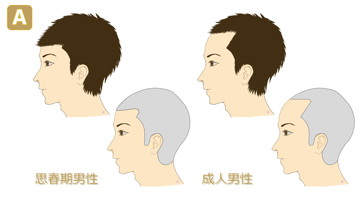 20歳代の生え際変化
