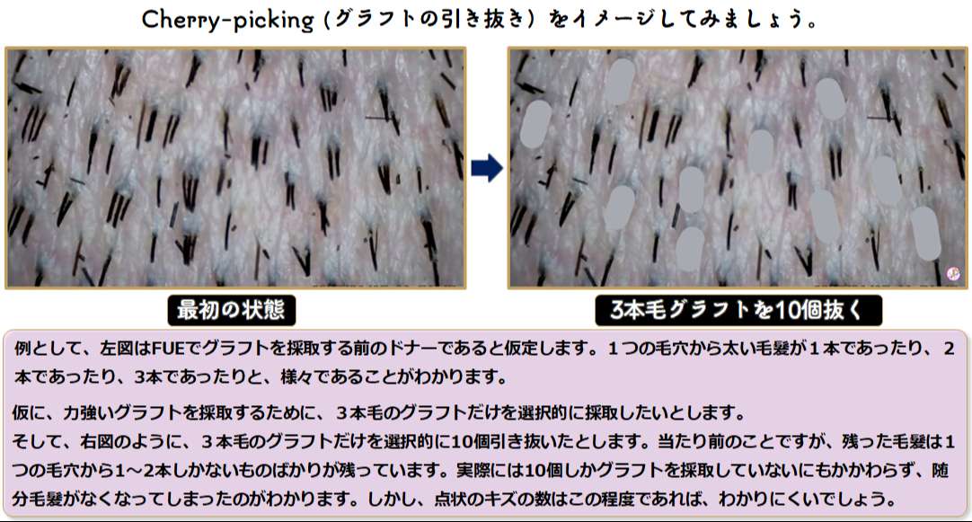 選択的グラフト採取の利点