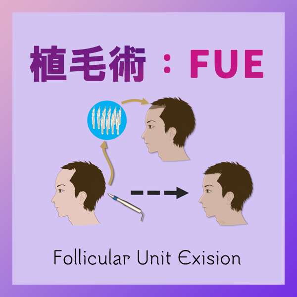 FUE