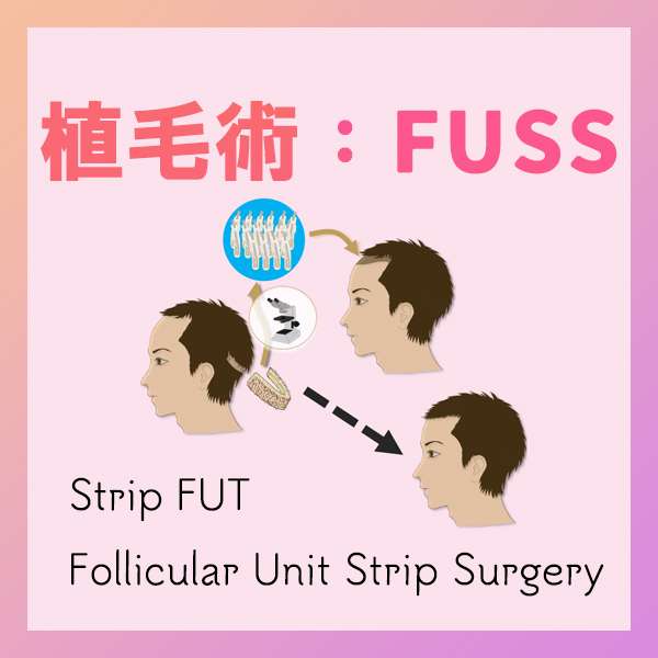 FUT/FUSS