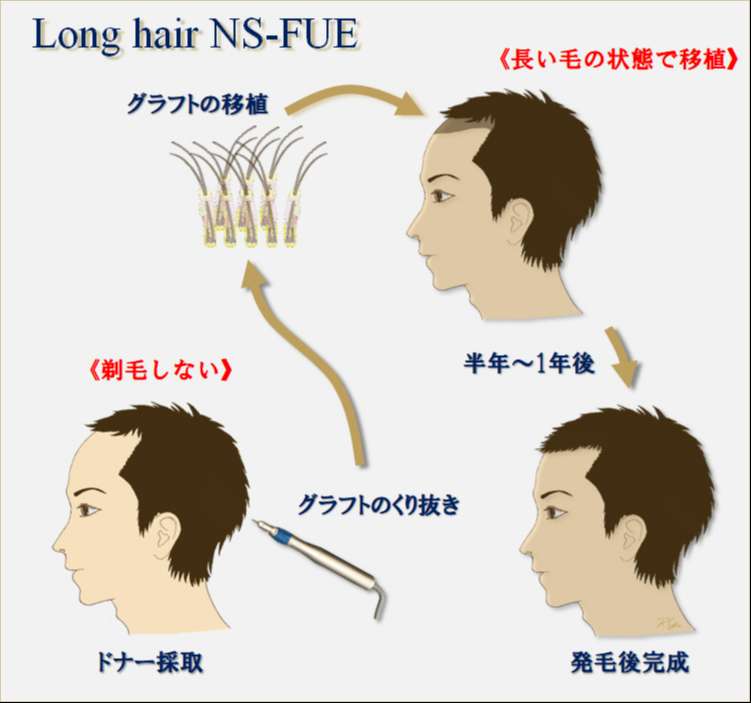 Long hair NS-FUE