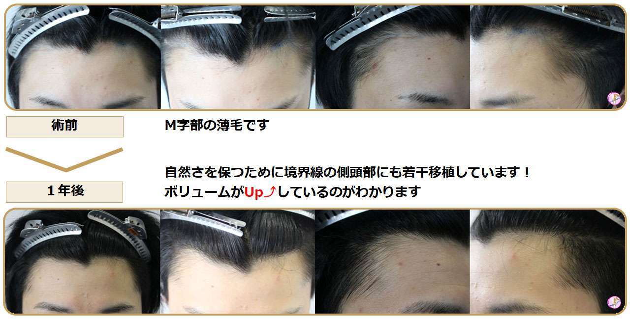 術前術後写真
