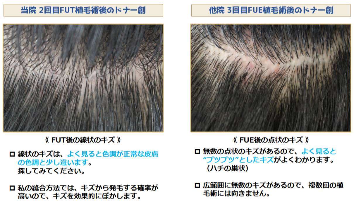 FUTとFUEのドナー創の比較写真
