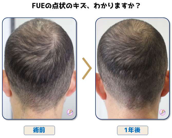 術後ドナー部