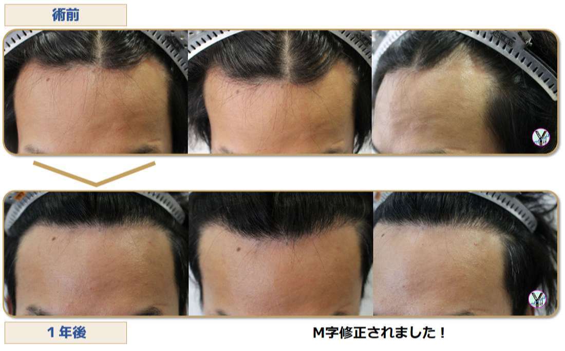 術前術後写真