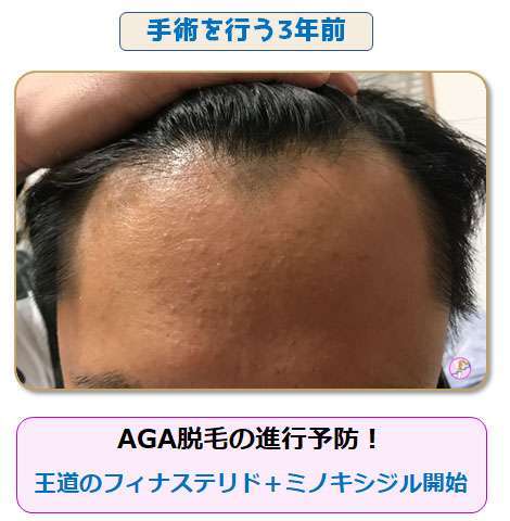 AGA薬剤投与開始前写真