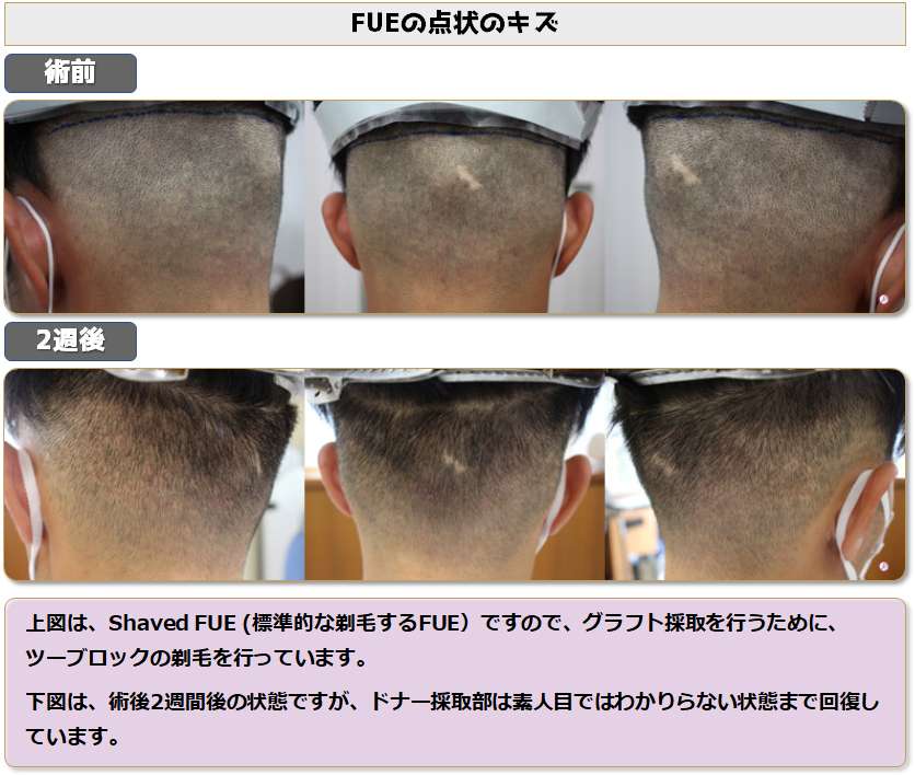 FUEで後頭部を剃毛した場合