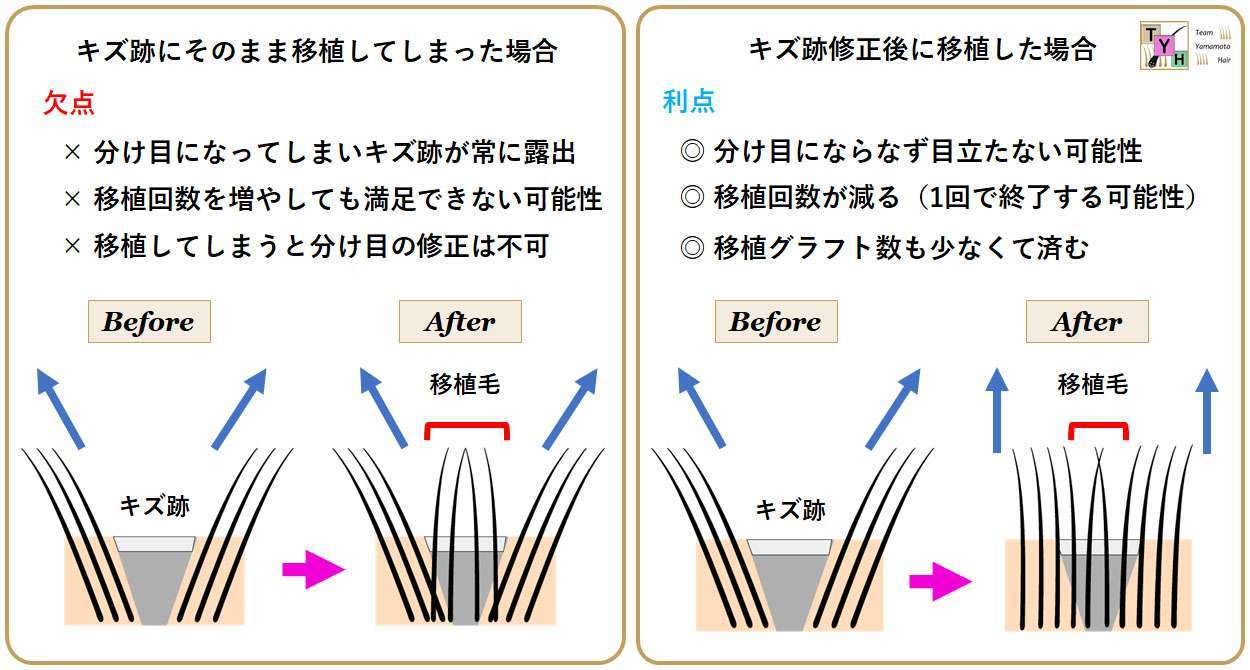 独自の瘢痕部修正術