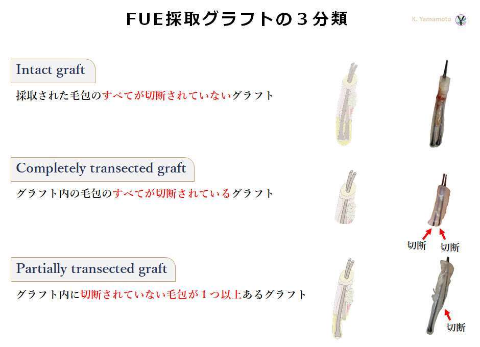 FUEにおける採取グラフトの3分類