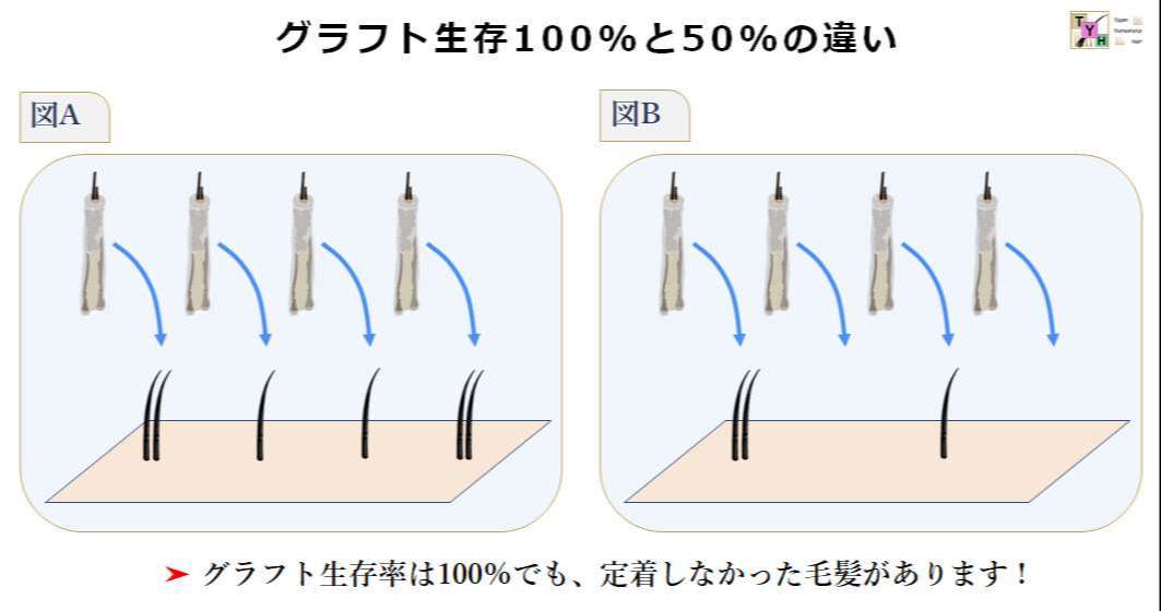 グラフト生存率100％と50％の違い