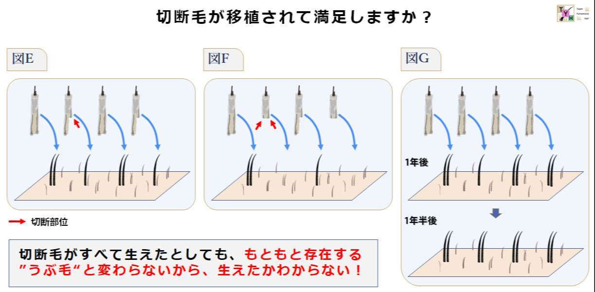 切断毛が移植されても結果的にほとんど生えていないように見える