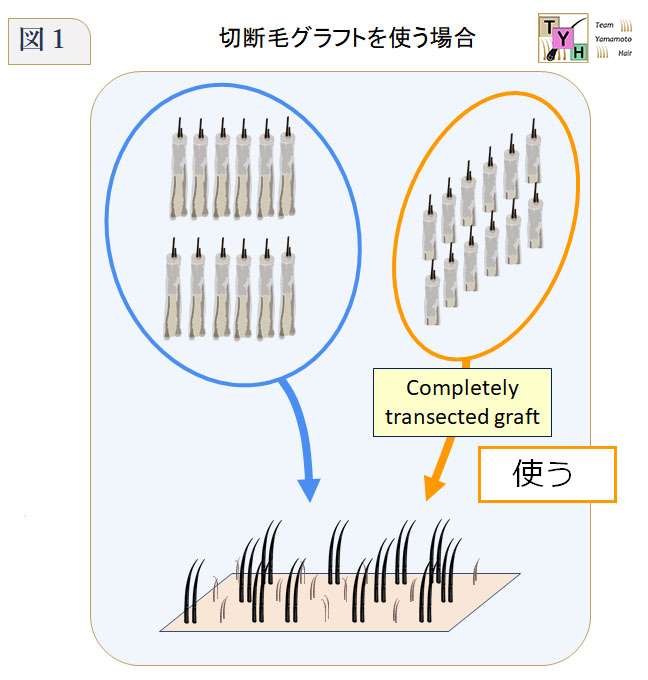 切断毛グラフトであるCompletely transected graftを移植した場合