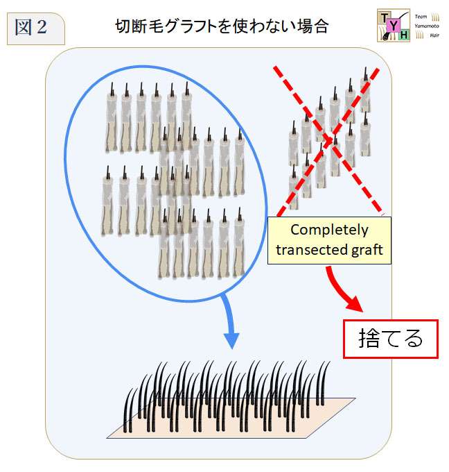 切断毛グラフトであるCompletely transected graftを捨てた場合