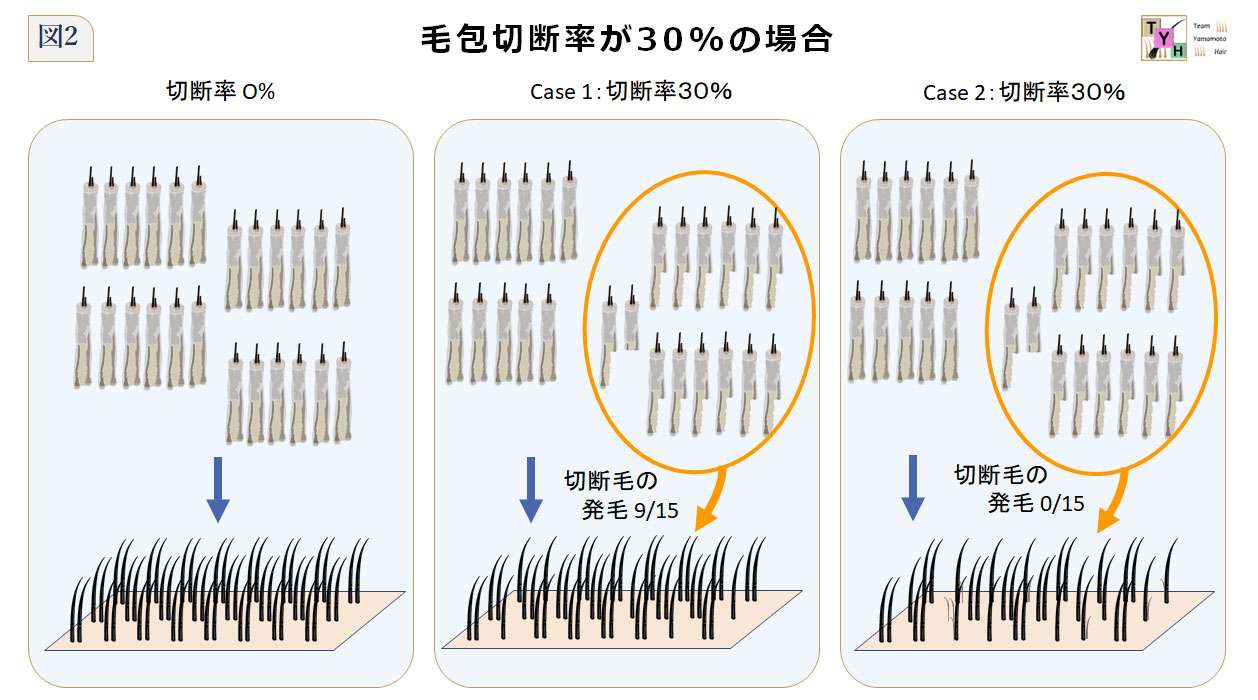 毛包切断率FTRが30%の場合