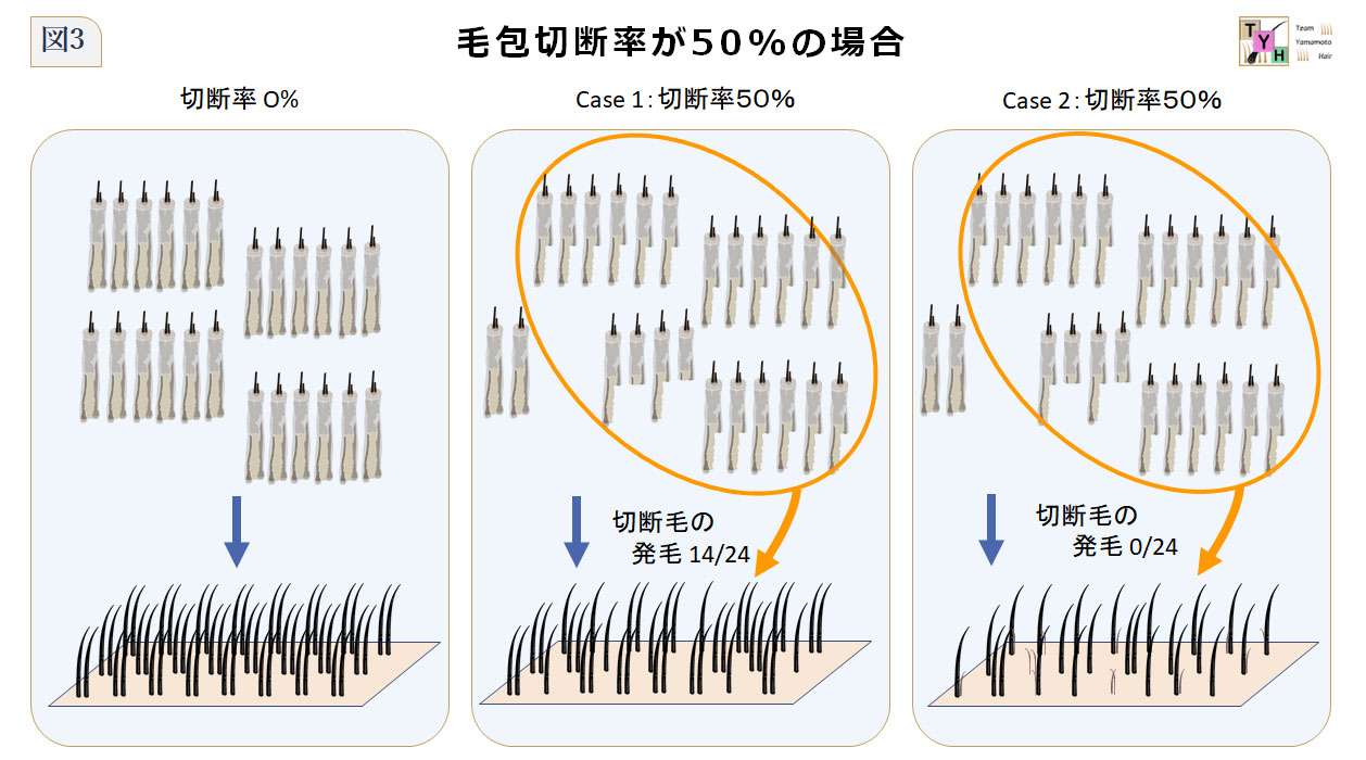 毛包切断率FTRが50%の場合