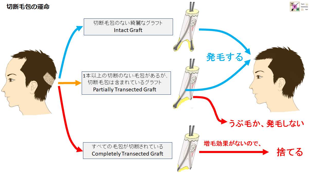 FUEでの毛包切断による運命