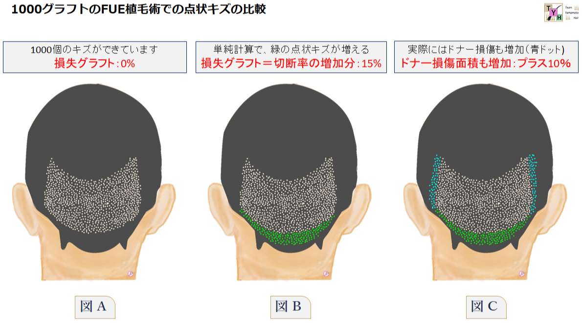 毛包切断によるドナーの影響