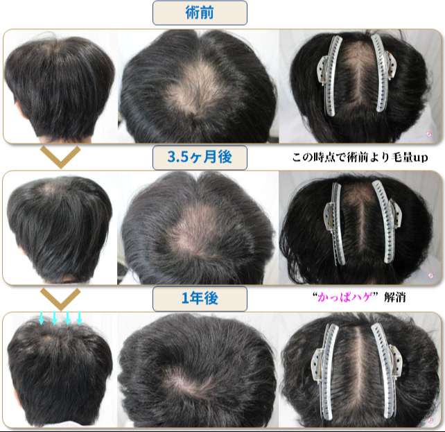 つむじ中心と生え際の術前・術後写真
